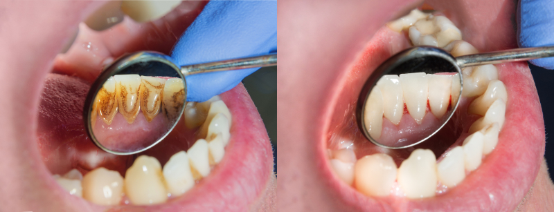 Gum care before and after